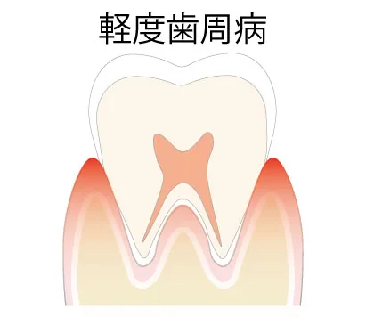 軽度歯周病