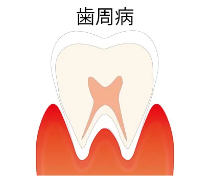 重度歯周病