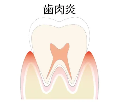 歯周病の手前段階＜歯肉炎＞