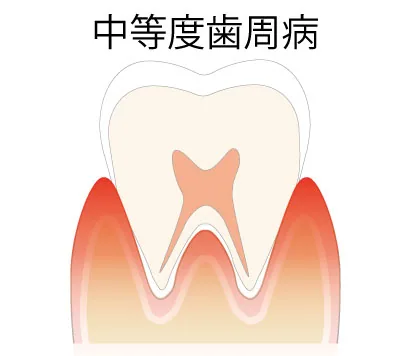 中等度歯周病